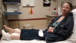 Sprained Ankle